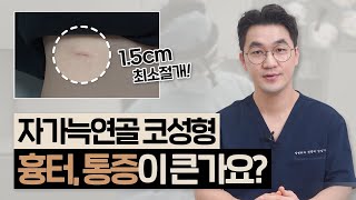 자가늑연골 흉터, 통증 걱정?🤔｜1.5cm 최소절개｜와핑, 장점, 단점 코성형 재료 Q&A