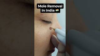 Remove Mole from My Face | Mridul Madhok