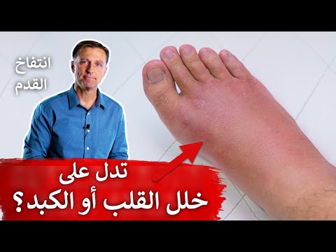 فيديو: هل يمكن أن تسبب الوذمة أرجل حمراء؟