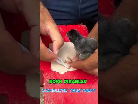 'Clubfoot Treatment: Ponseti Method Serial