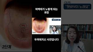혀 백태가 노랗게 되는 과정 #황태 #노란색혀