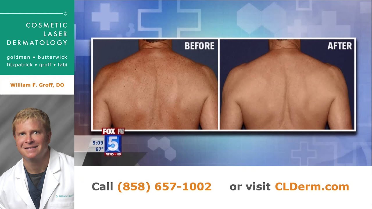 Banner for Ask the Derm: Dr. Groff Discusses Kybella and Other Skin Issues