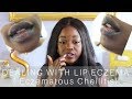 Dealing with | Eczematous Cheilitis Lip Eczema