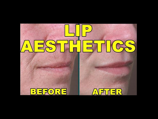 LIP AESTHETICS | PLUMPING LIPS | LIP FILLERS | HOW TO BRIGHTEN DARK LIPS?| Before and After