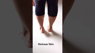 Subscribe plz #instareel #yogaskills #motivation #yogapractice #yogaroutine #vericoseveins #therapy