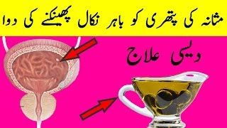 Masane Ki Pathri - Stone Remove In Body With Out Pain