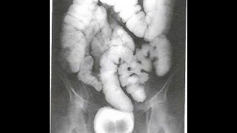 RADS. 102   Distortion