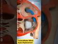 ALtavalve : Transcatheter Mitral valve Replacement #2023shorts#youtubeshorts