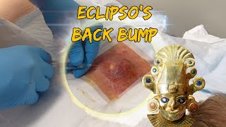 Eclipso's Massive Back Bump - Excision and Packing - NEW!