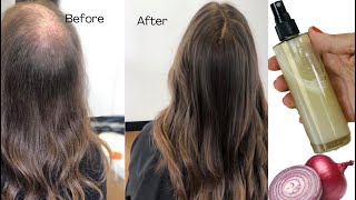 ONION JUICE FOR RAPID HAIR GROWTH Stop Hair loss and Grow Thick Hair