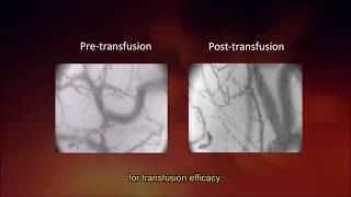 Effect of Blood Transfusion on Microcirculation