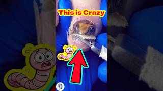 Cleaning Infected Fungal Toenail Asmr