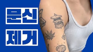 강남역 문신제거 |  #조아성형외과 #JOAPlasticSurgery