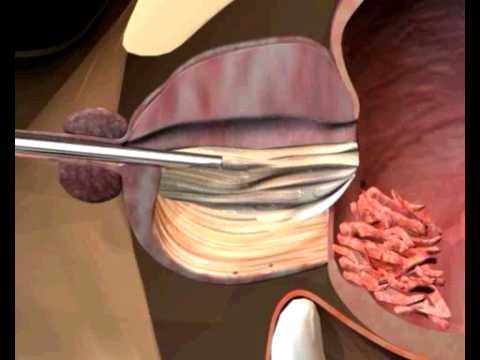 Трансуретральна резекція простати (ТУРП)