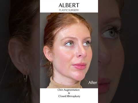 Video thumbnail: Our lovely patient wanted to improve her profile. · Albert Plastic Surgery New York