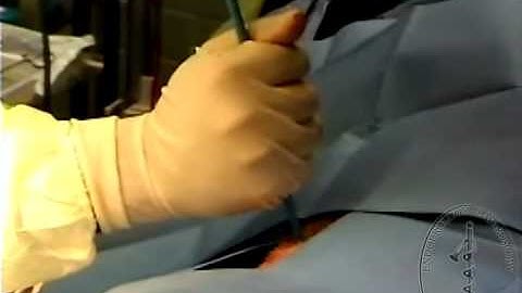 Percutaneous Nephrolithotomy - Tract dilation using Amplatz sheath