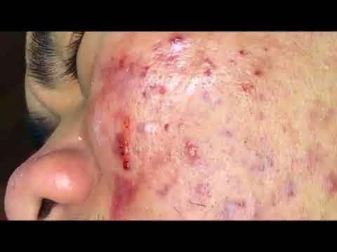 (AMAZING) !!! BEST BLACKHEAD REMOVE AND CYSTIC  REMOVE ON FACE (PART )
