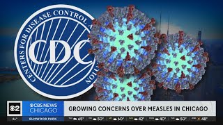 Growing concerns over measles in Chicago