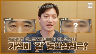 '가성비 갑' 동안성형은? 눈밑성형 하안검 케이스별로 알려드립니다^^ [🇺🇸, 🇯🇵 SUB]