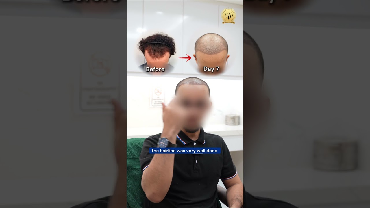 Hair Transplant Day 7 Check-in: From Yemen! ✈️ #hairtransplantmalaysia