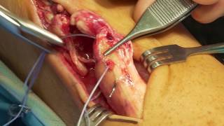 Achilles Tendon Repair with Krakow procedure (Dr. Econopouly)