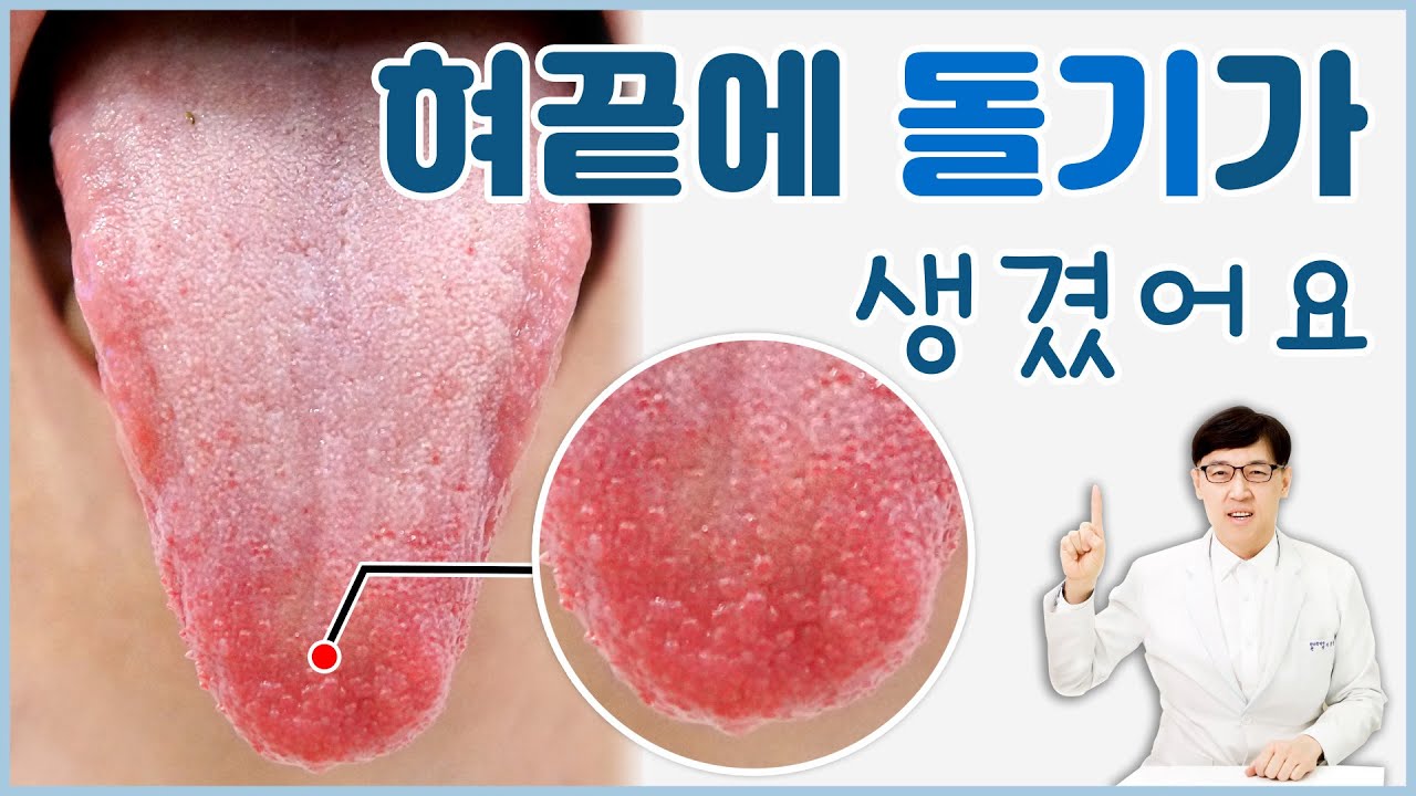 혀끝에 돌기가 생겼는데요. 점점 많아지면서 혀가 갈라져요 - YouTube