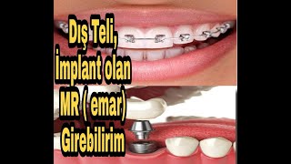 Di̇ş İmplant Ve Di̇ş Teli̇ İle Mr Emer A Gi̇ri̇li̇rmi̇ ? Pantolon Fermuari Sütyen İle Mr Emar A Gi̇ri̇li̇rmi̇