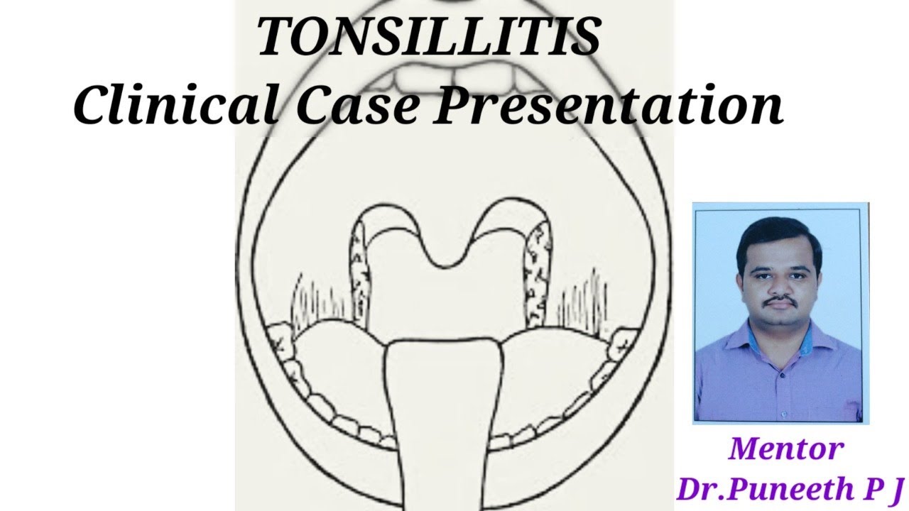 a case study on tonsillitis