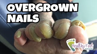 Overgrown Toe Nails