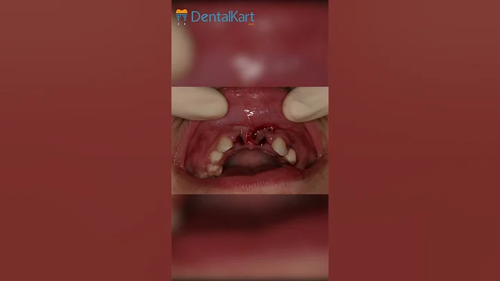 MANAGEMENT OF TOOTH AVULSION |  #dentalworld #teeth #dentalprocedure #dentaltreatment #waldent - DayDayNews