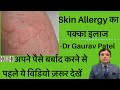 स्किन ऐलर्जी का इलाज।Skin Allergy Treatment At Home| By Dermatologist Dr Gaurav Patel #skinallergy