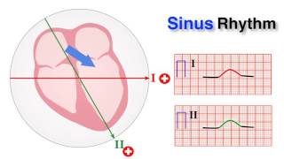 ECG basics 7/10 - Determining Normal Sinus Rhythm