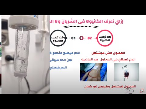 ماذا يحدث اذا تم تركيب الكانيولا فى الشريان بدلا من الوريد     