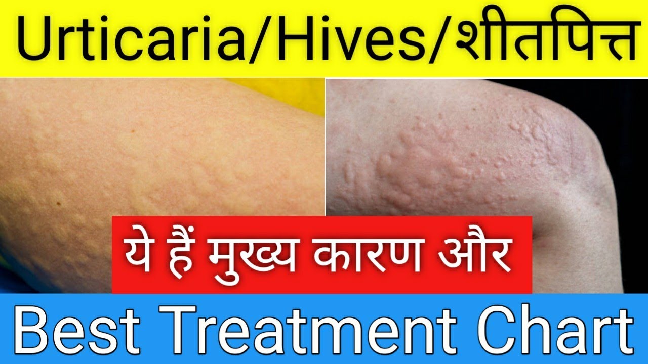 Skin Rash, Urticaria, Hives Causes, Types, Symptoms I Urticaria Hives