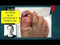 Video - hypergranulation tissue resection on a bad ingrown toenail