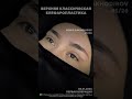 2026. Operatsiya 5😍 #nodirbakhodirov  #blefaroplastika #blepharoplasty #operatsiya #doposle