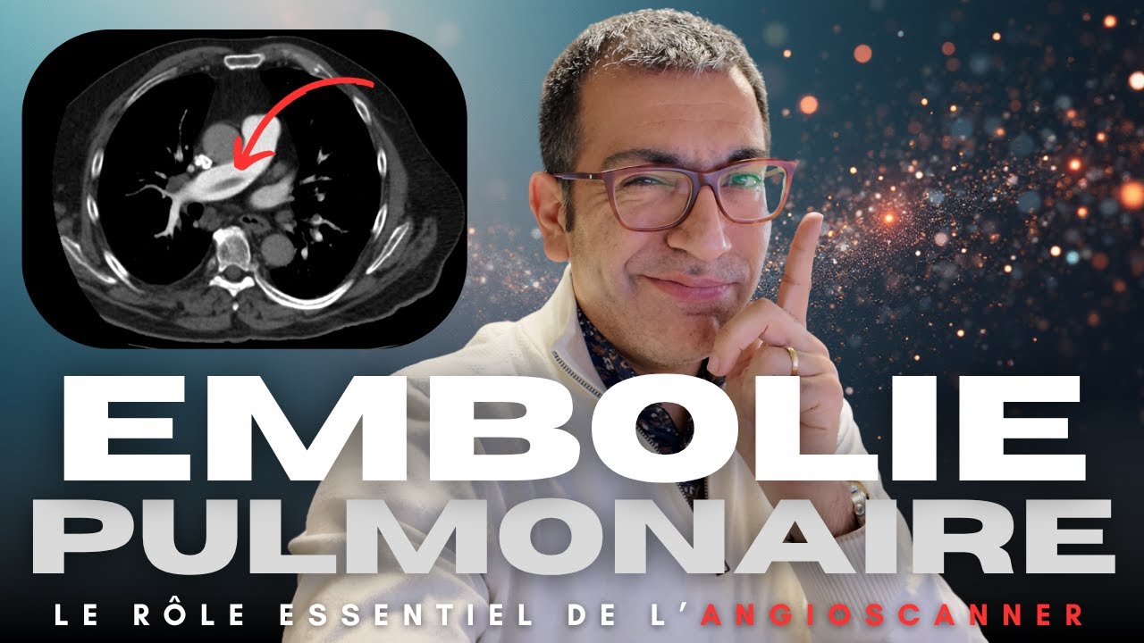 Embolie pulmonaire : pourquoi l'angioscanner est indispensable ? (Bonus : les dernières guidelines)