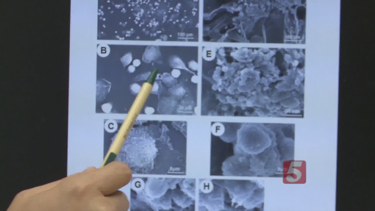 Sjogren’s Disease Causes Dry Mouth YouTube