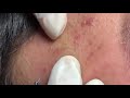 #024 | Inflammatory acne, SWELLING throughout the face | Hương Đà Nẵng