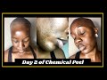 Vlog sur les soins de la peau jour 2 de mon peeling chimique pour une hyperpigmentation et une texture plus lisse  mikara reid