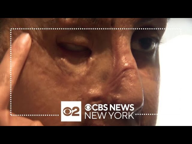 Long Island S Nafiah Ikram Continues To Heal 3 Years After Brutal Acid Attack