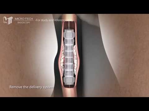 Esophageal Segmented Stent System