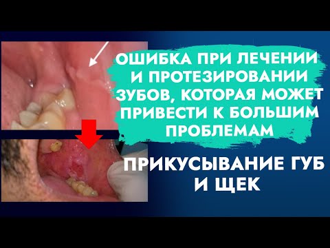 Прикусывание губ, щек. Ошибка при лечении, протезировании зубов, которая может привести к проблемам.