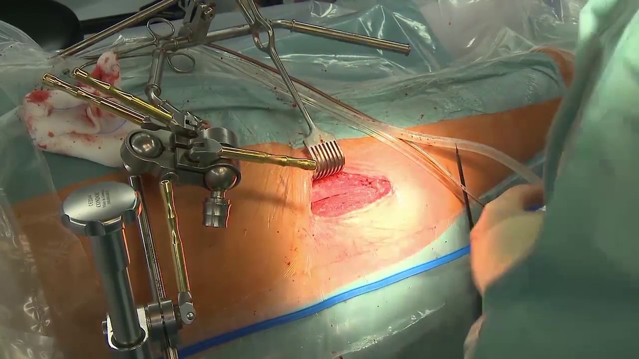 Live Chirurgie: Femto-Katarakt Operation mit dem Ziemer Z8 – Szurman