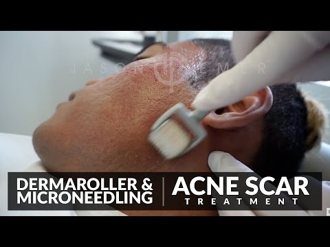 Microneedling for Acne Scars Treatment | Dermaroller Before and After | Skin Resurfacing | Dr. Jason