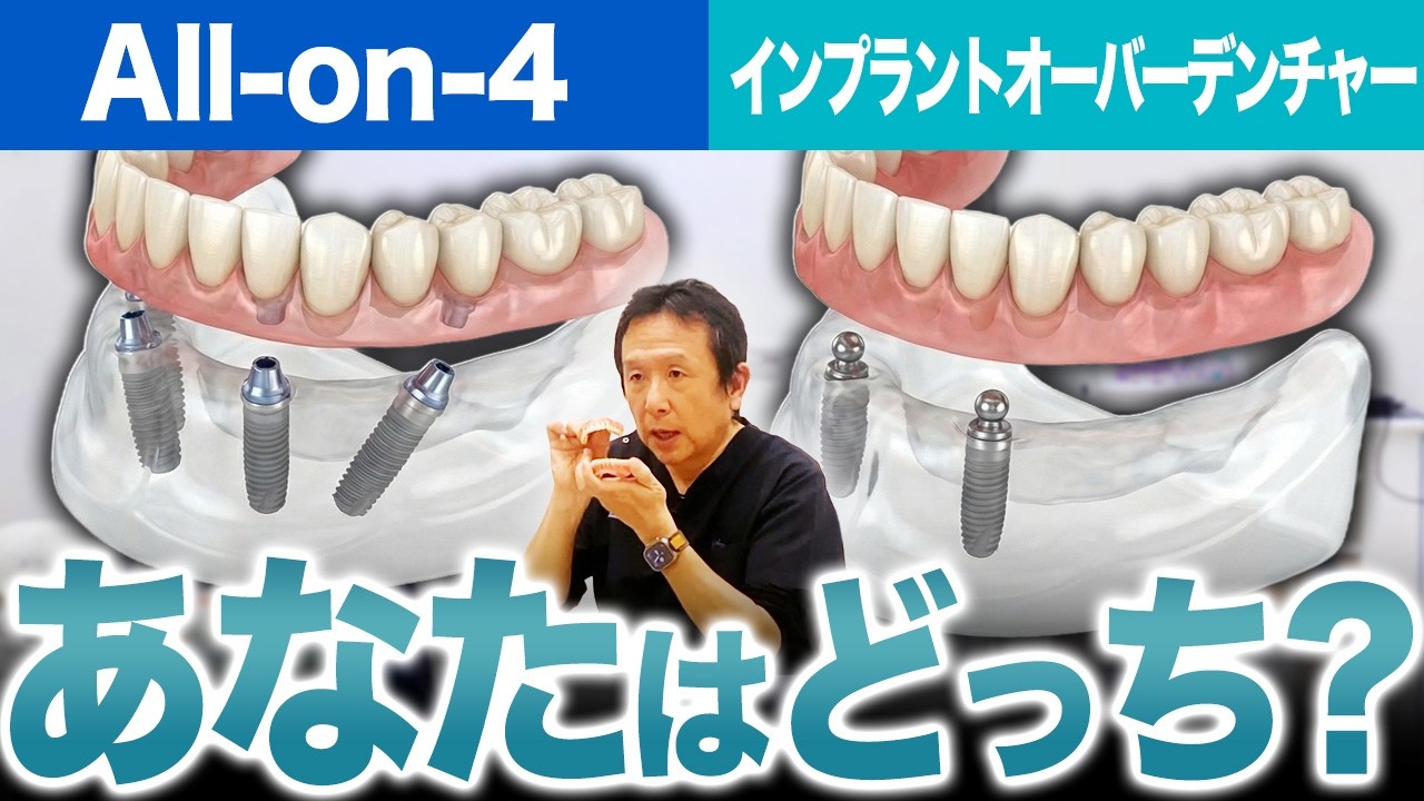 治療する前にみて！オールオン4とインプラントオーバーデンチャー