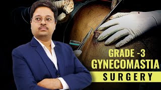 Gynecomastia Surgery || 360 Liposuction || Dr. Jayanta Bain plastic surgeon