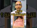 ما هي التينيا الملونة ما هي التينيا الملونة