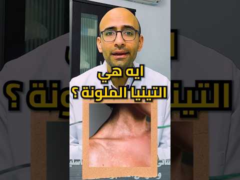 ما هي التينيا الملونة 