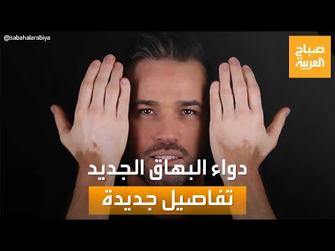 صباح العربية كل ما تريد معرفته عن الدواء المنزلي الجديد لعلاج البهاق